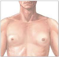 Gynecomastia